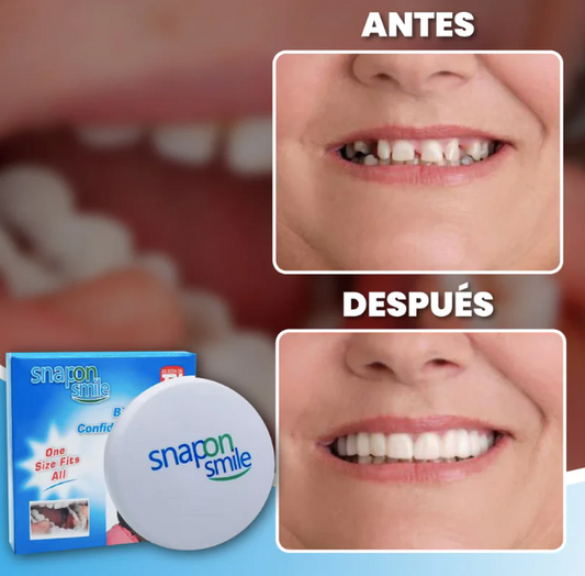 Carillas HappySmile dentales 🦷