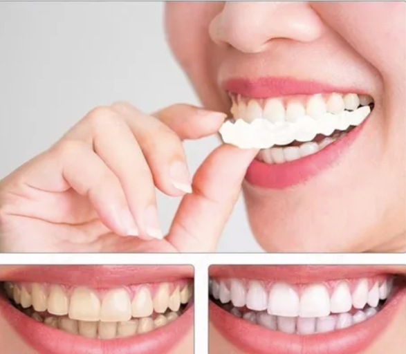Carillas HappySmile dentales 🦷